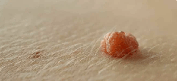 Virus do papiloma