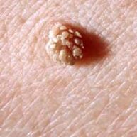 Virus do papiloma humano na pel