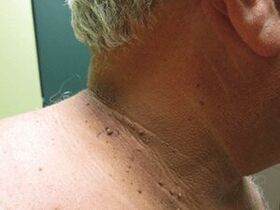 As razóns para a aparición de papilomas plurais no corpo