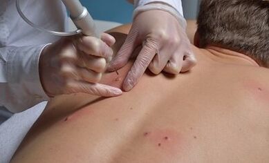 Formas de eliminar papilomas