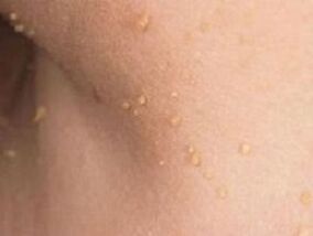 Razóns para a aparición de papilomas no corpo