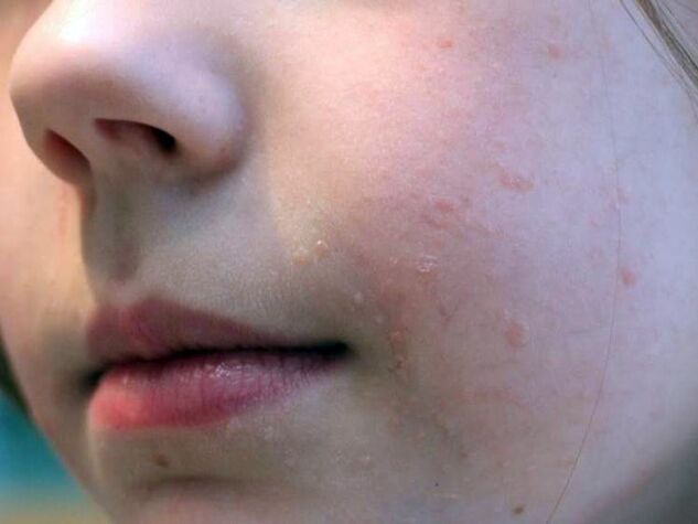 As verrugas planas na cara aparecen con máis frecuencia na adolescencia